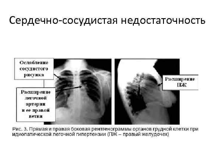 Сердечно-сосудистая недостаточность 