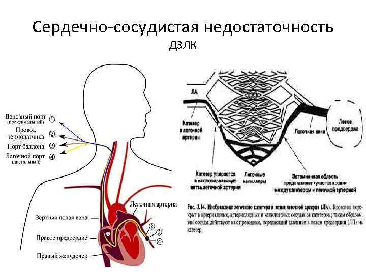 Сердечно-сосудистая недостаточность ДЗЛК 