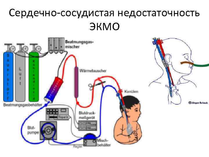 Сердечно-сосудистая недостаточность ЭКМО 