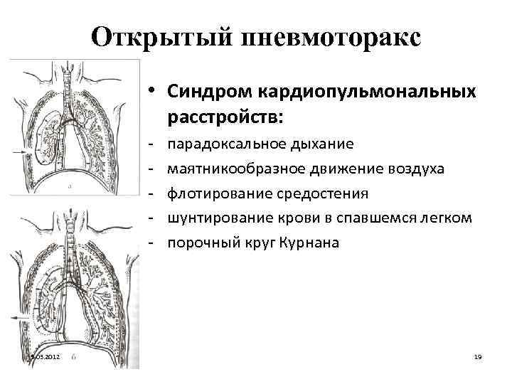 Открытый пневмоторакс • Синдром кардиопульмональных расстройств: - 5. 03. 2012 парадоксальное дыхание маятникообразное движение