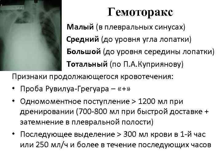 Гемоторакс Малый (в плевральных синусах) Средний (до уровня угла лопатки) • Большой (до уровня