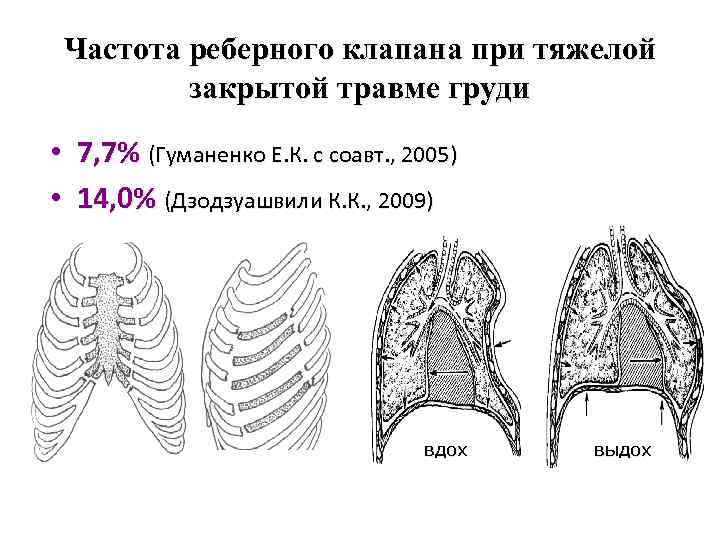 Частота реберного клапана при тяжелой закрытой травме груди • 7, 7% (Гуманенко Е. К.