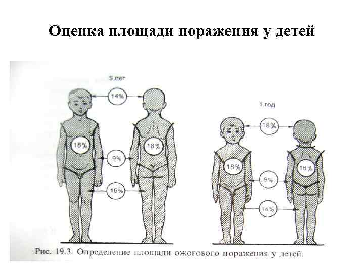 Оценка площади поражения у детей 