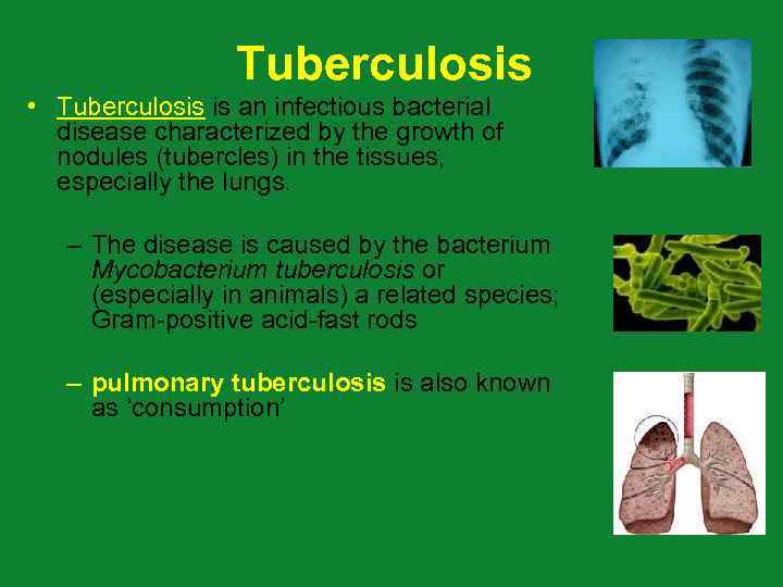 Tuberculosis • Tuberculosis is an infectious bacterial disease characterized by the growth of nodules