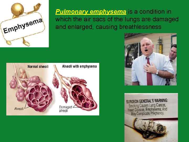 Pulmonary emphysema is a condition in which the air sacs of the lungs are