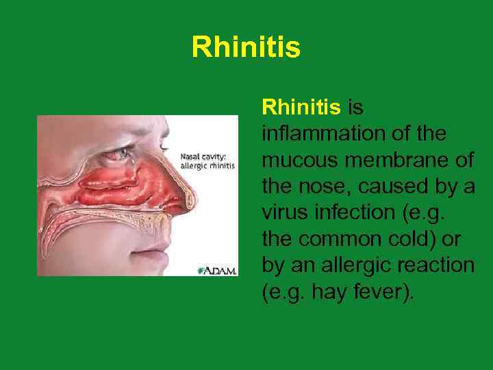 Rhinitis is inflammation of the mucous membrane of the nose, caused by a virus