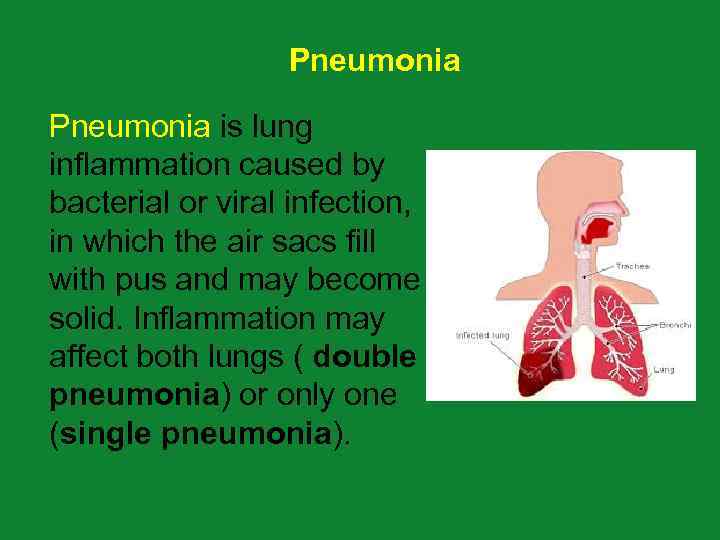 Pneumonia is lung inflammation caused by bacterial or viral infection, in which the air