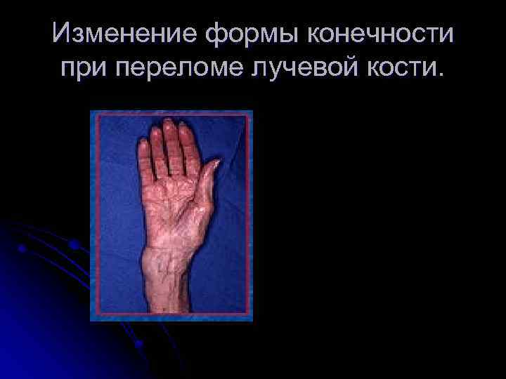 Изменение формы конечности при переломе лучевой кости. 