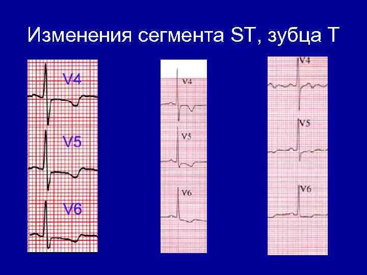 Изменения сегмента ST, зубца Т 