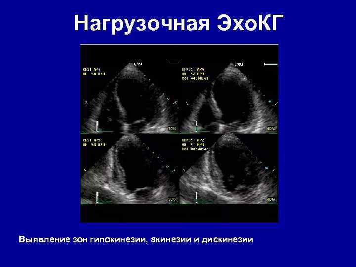 Нагрузочная Эхо. КГ Выявление зон гипокинезии, акинезии и дискинезии 
