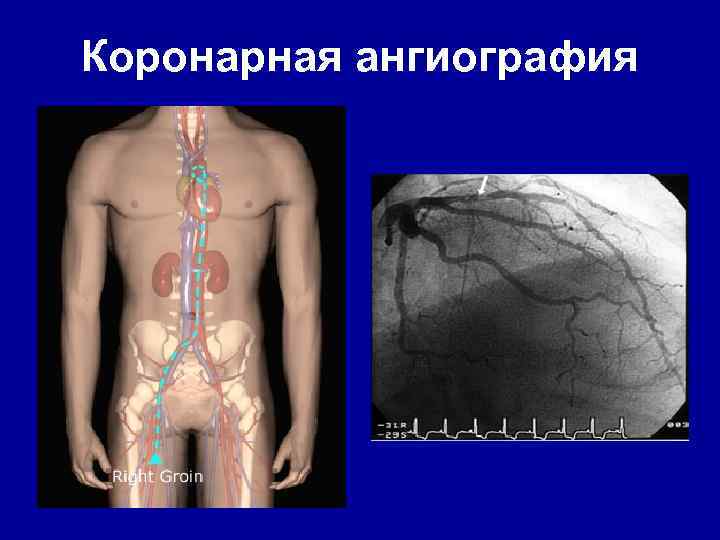 Коронарная ангиография 