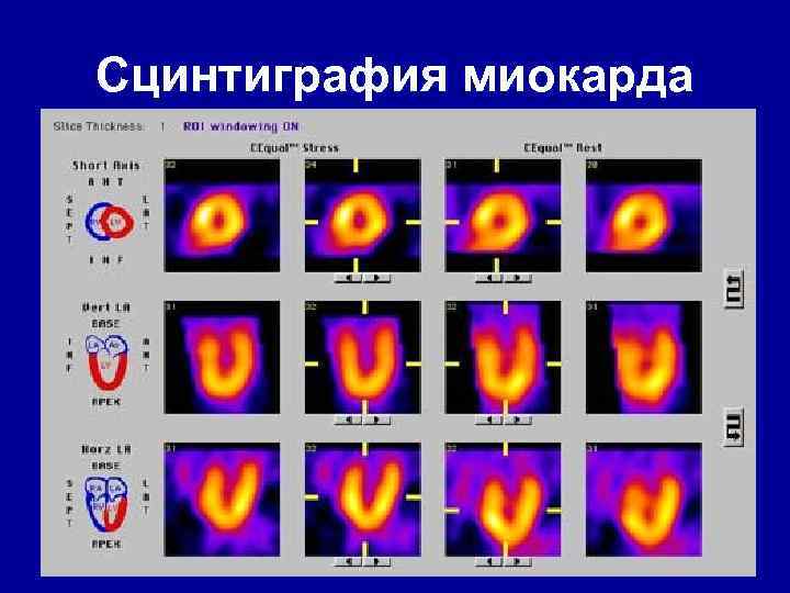 Сцинтиграфия миокарда 