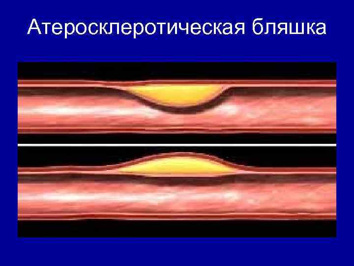 Атеросклеротические атеросклеротические поражения конечностей. Циркулярная атеросклеротическая бляшка. Экранирующая атеросклеротическая бляшка. Фиброзная атеросклеротическая бляшка 1,6 им. Пролонгированная атеросклеротическая бляшка – это.