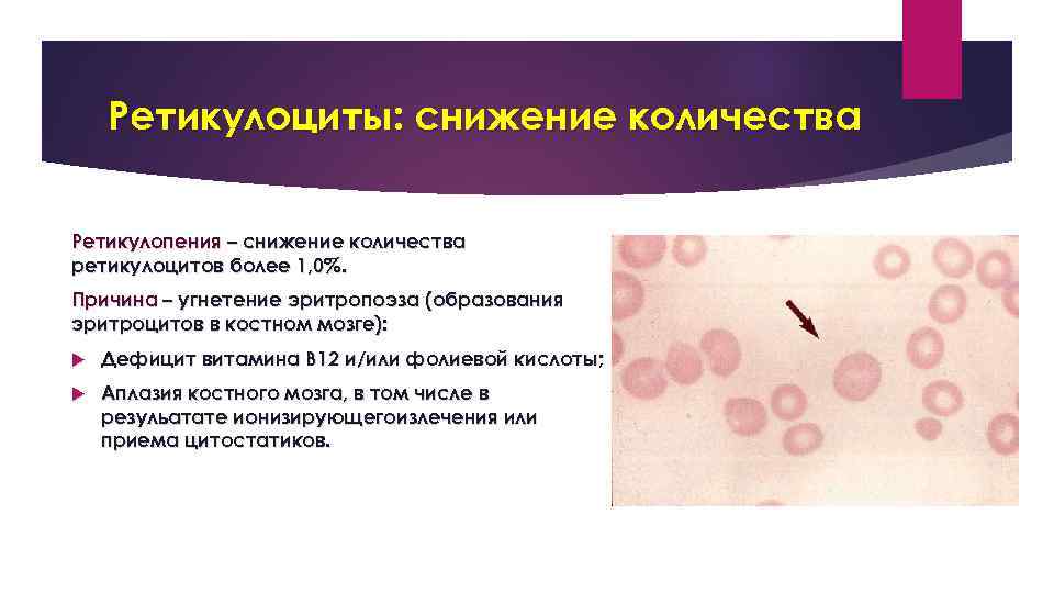 Ретикулоциты: снижение количества Ретикулопения – снижение количества ретикулоцитов более 1, 0%. Причина – угнетение