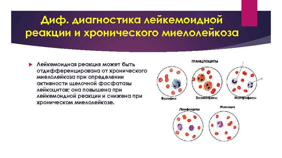 Диф. диагностика лейкемоидной реакции и хронического миелолейкоза Лейкемоидная реакция может быть отдифференцирована от хронического