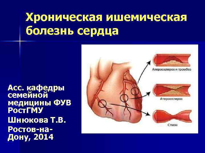 Хроническая ишемическая болезнь сердца Асс. кафедры семейной медицины ФУВ Рост. ГМУ Шнюкова Т. В.