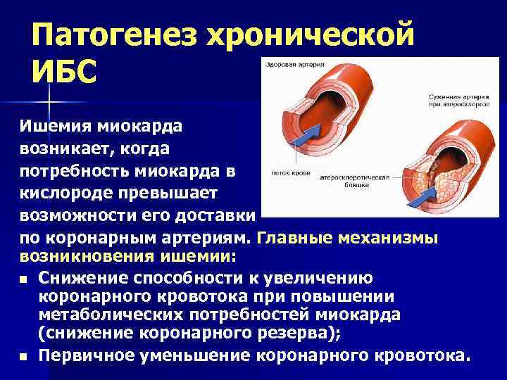 Патогенез хронической ИБС Ишемия миокарда возникает, когда потребность миокарда в кислороде превышает возможности его