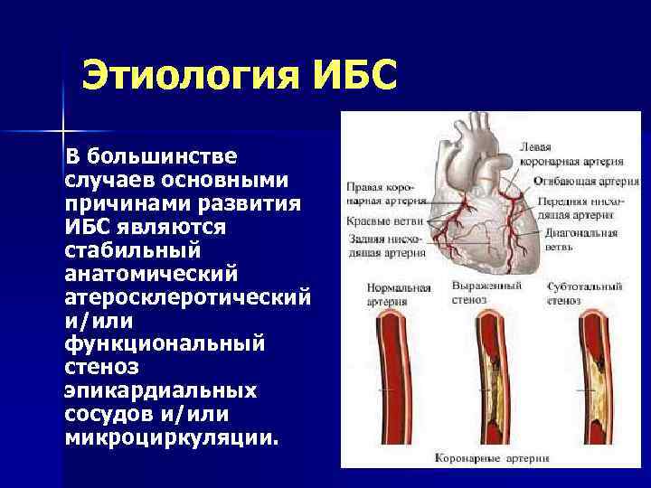 Этиология ИБС В большинстве случаев основными причинами развития ИБС являются стабильный анатомический атеросклеротический и/или