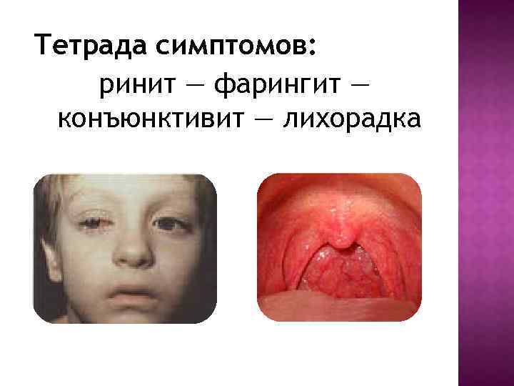 Тетрада симптомов: ринит — фарингит — конъюнктивит — лихорадка 