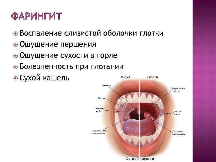 ФАРИНГИТ Воспаление слизистой оболочки глотки Ощущение першения Ощущение сухости в горле Болезненность при глотании