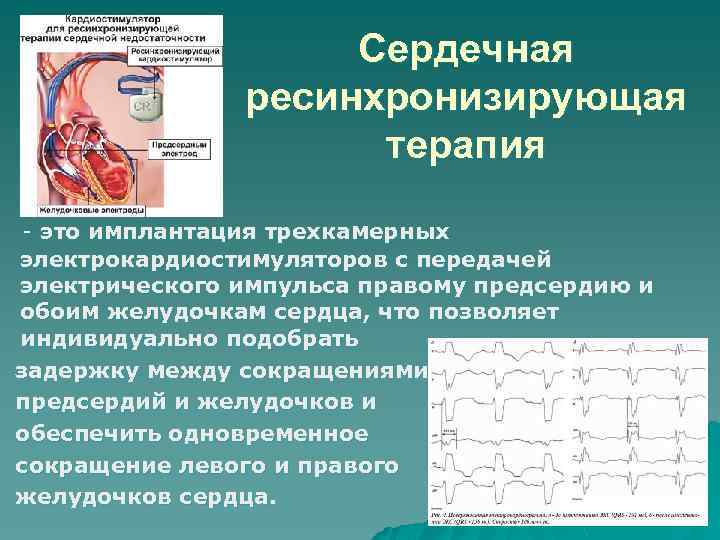 Сердечная ресинхронизирующая терапия - это имплантация трехкамерных электрокардиостимуляторов с передачей электрического импульса правому предсердию