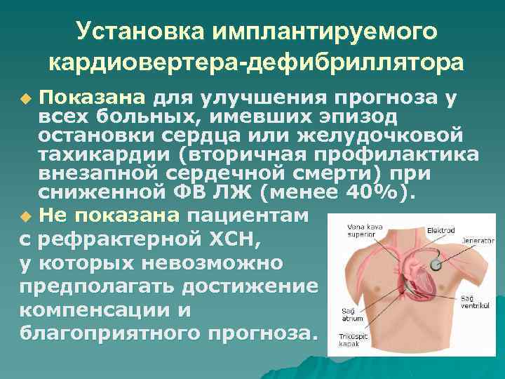Установка имплантируемого кардиовертера-дефибриллятора Показана для улучшения прогноза у всех больных, имевших эпизод остановки сердца