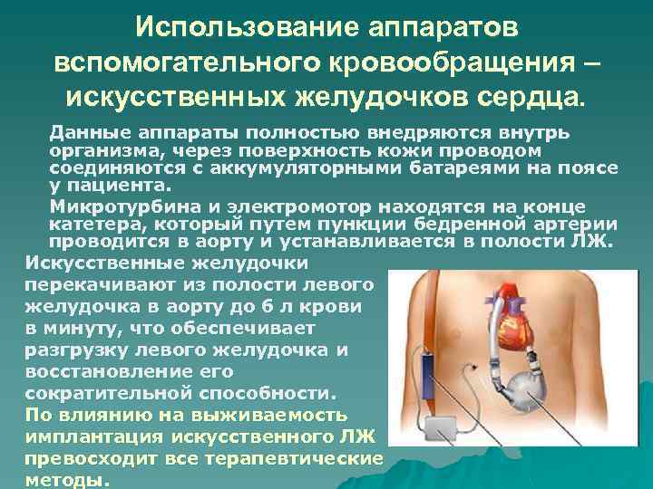 Использование аппаратов вспомогательного кровообращения – искусственных желудочков сердца. Данные аппараты полностью внедряются внутрь организма,