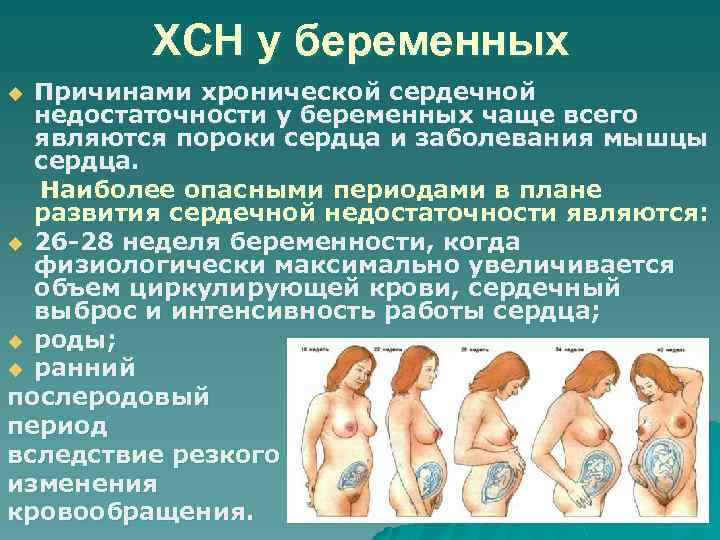 ХСН у беременных Причинами хронической сердечной недостаточности у беременных чаще всего являются пороки сердца
