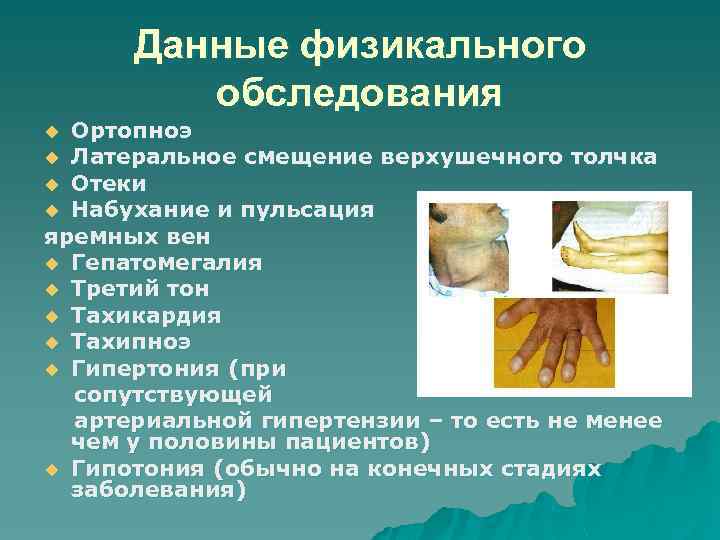 Данные физикального обследования Ортопноэ u Латеральное смещение верхушечного толчка u Отеки u Набухание и