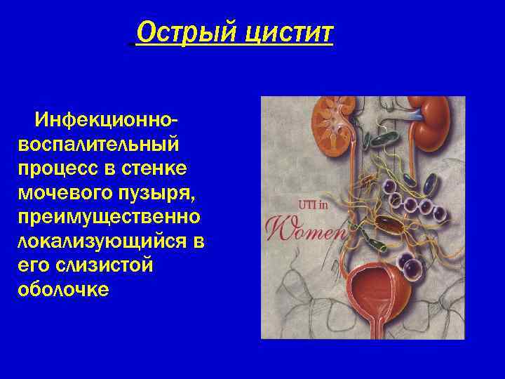 Острый цистит Инфекционновоспалительный процесс в стенке мочевого пузыря, преимущественно локализующийся в его слизистой оболочке
