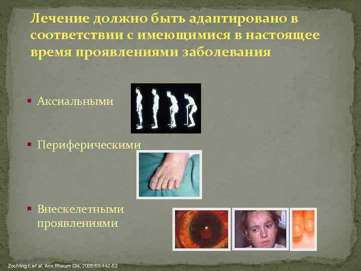 Лечение должно быть адаптировано в соответствии с имеющимися в настоящее время проявлениями заболевания §