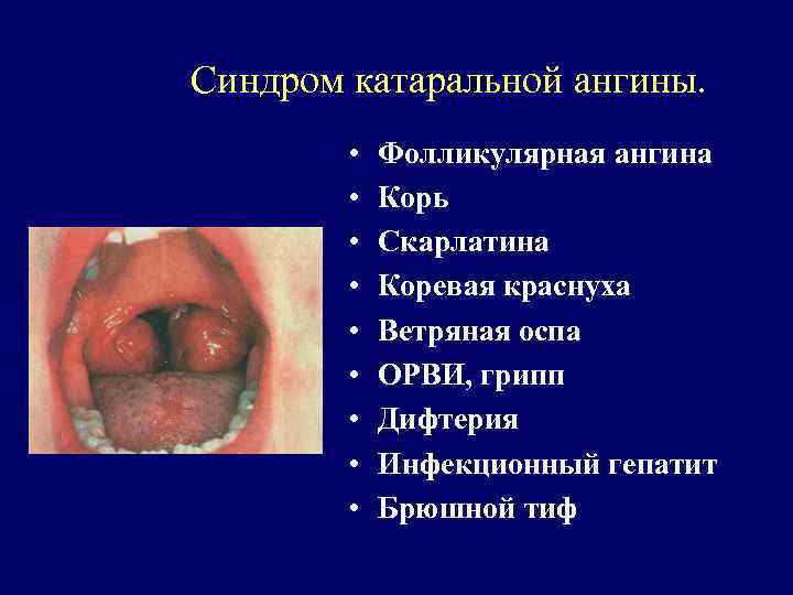 Синдром катаральной ангины. • • • Фолликулярная ангина Корь Скарлатина Коревая краснуха Ветряная оспа