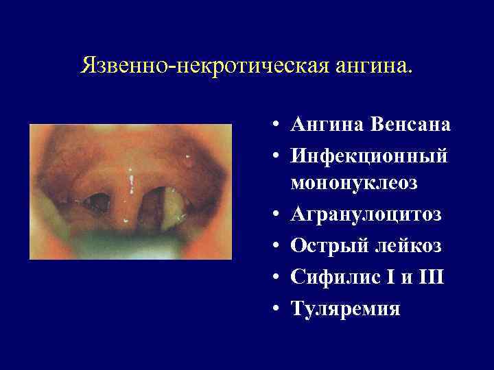 Язвенно-некротическая ангина. • Ангина Венсана • Инфекционный мононуклеоз • Агранулоцитоз • Острый лейкоз •