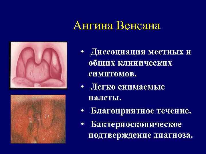 Ангина Венсана • Диссоциация местных и общих клинических симптомов. • Легко снимаемые налеты. •