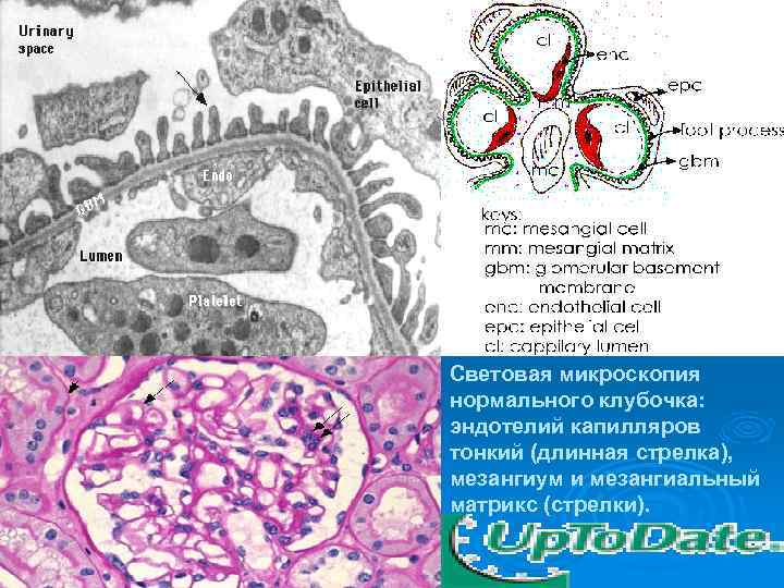 Cветовая микроскопия нормального клубочка: эндотелий капилляров тонкий (длинная стрелка), мезангиум и мезангиальный матрикс (стрелки).