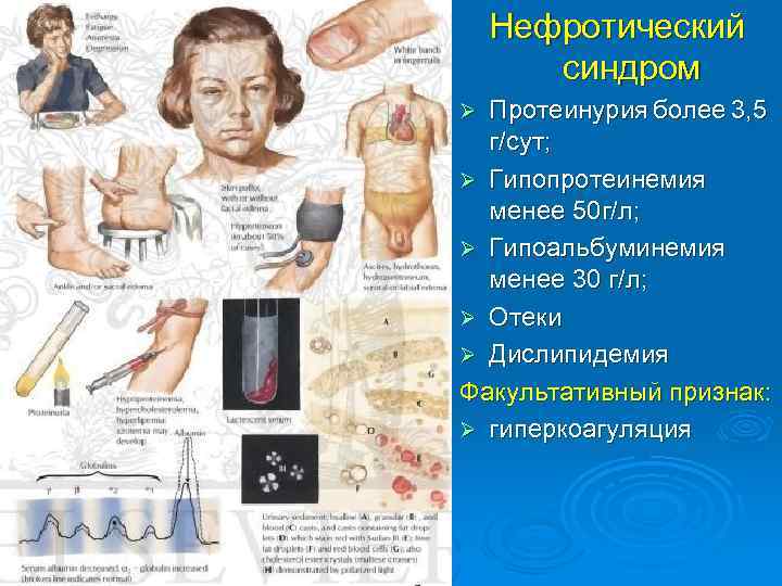 Нефротический синдром Протеинурия более 3, 5 г/сут; Ø Гипопротеинемия менее 50 г/л; Ø Гипоальбуминемия