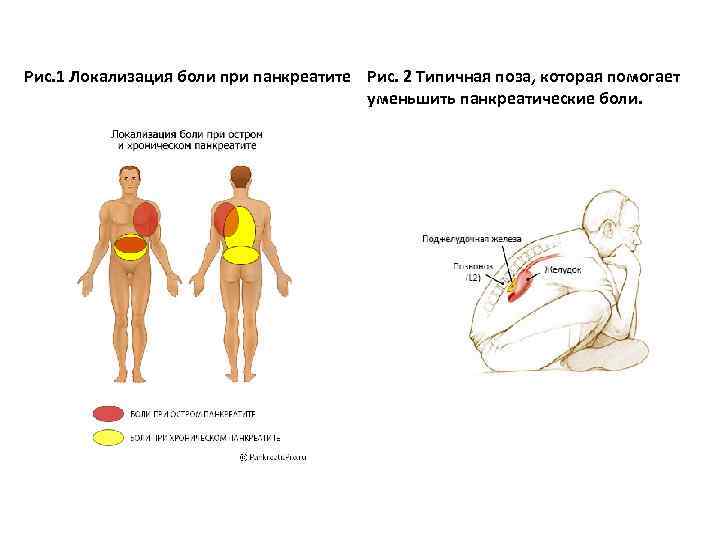 Рис. 1 Локализация боли при панкреатите Рис. 2 Типичная поза, которая помогает уменьшить панкреатические