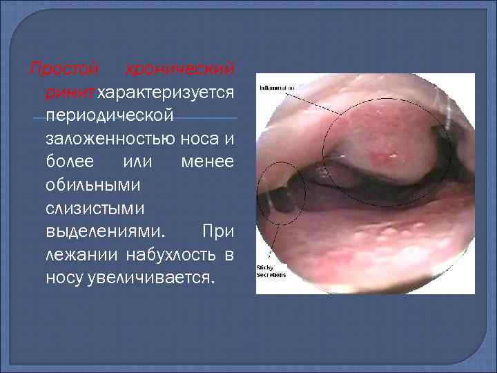 Простой хронический ринит характеризуется периодической заложенностью носа и более или менее обильными слизистыми выделениями.