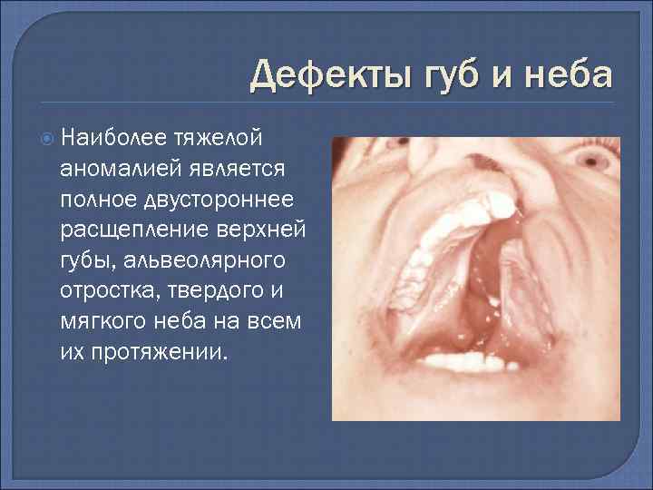 Дефекты губ и неба Наиболее тяжелой аномалией является полное двустороннее расщепление верхней губы, альвеолярного