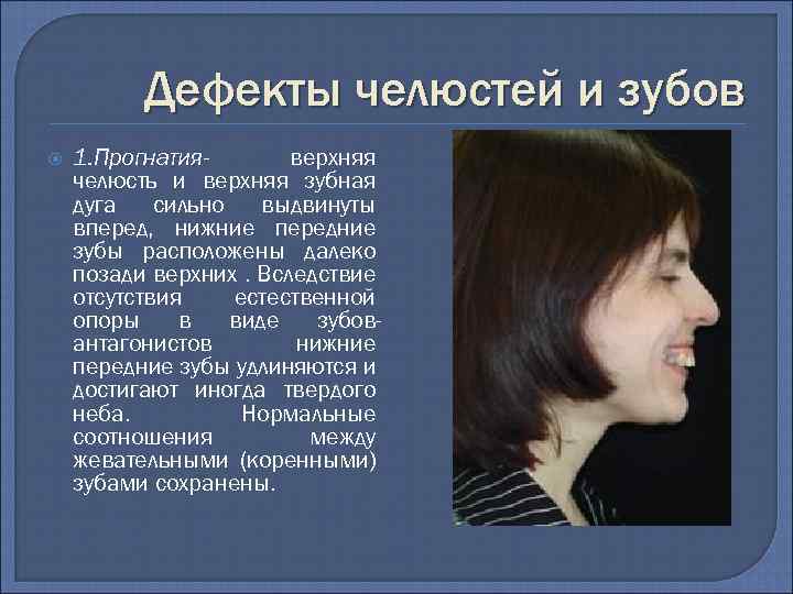 Дефекты челюстей и зубов 1. Прогнатияверхняя челюсть и верхняя зубная дуга сильно выдвинуты вперед,