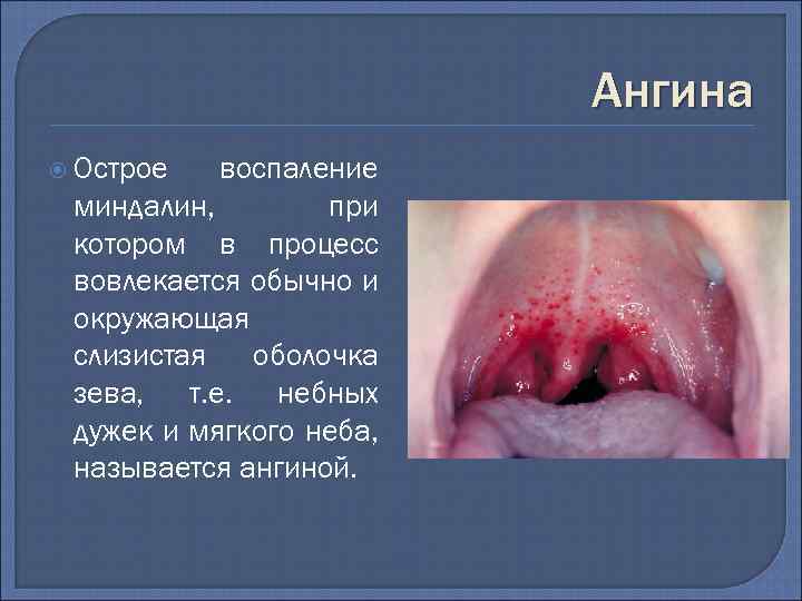 Ангина Острое воспаление миндалин, при котором в процесс вовлекается обычно и окружающая слизистая оболочка