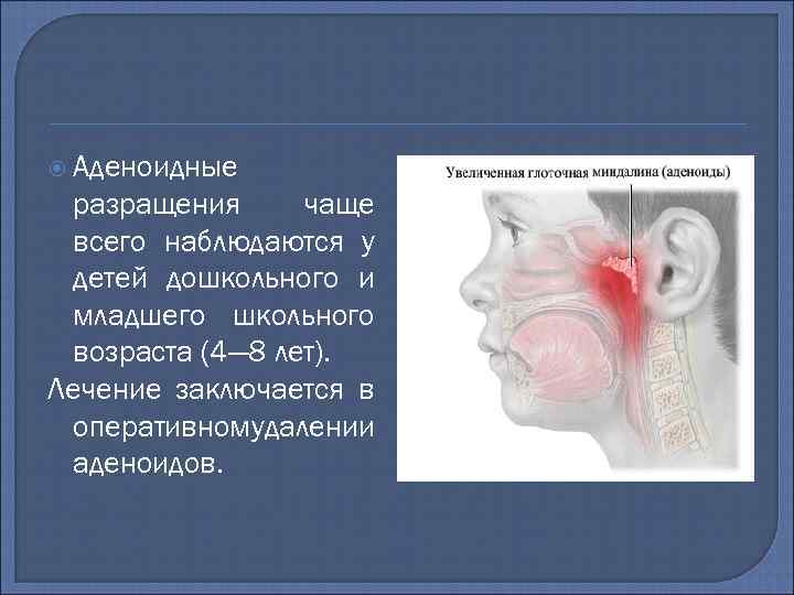  Аденоидные разращения чаще всего наблюдаются у детей дошкольного и младшего школьного возраста (4—