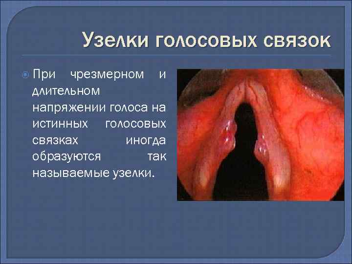 Узелки голосовых связок При чрезмерном и длительном напряжении голоса на истинных голосовых связках иногда