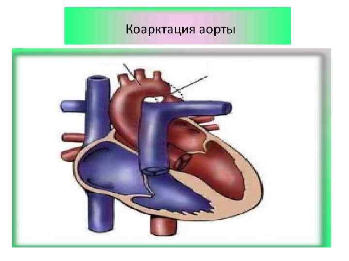 Жүректің туа біткен ақаулары презентация