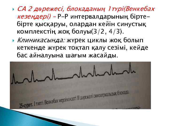  СА 2 дәрежесі, блокаданың 1 түрі(Венкебах кезеңдері) – Р-Р интервалдарының бірте қысқаруы, олардан