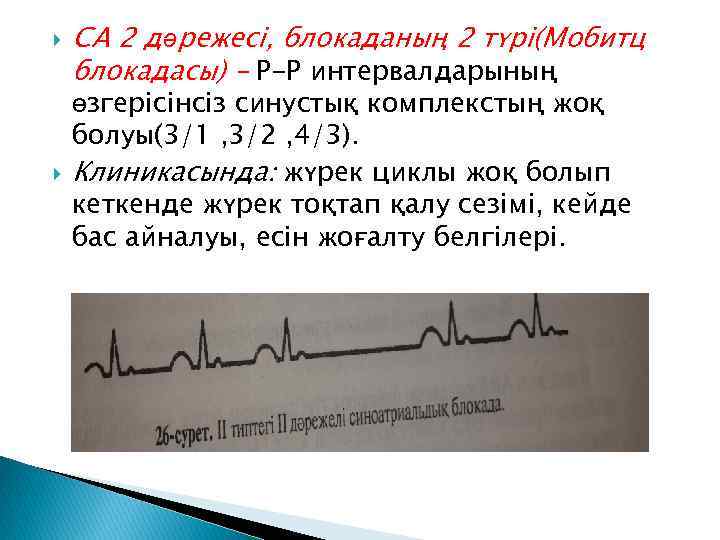  СА 2 дәрежесі, блокаданың 2 түрі(Мобитц блокадасы) – Р-Р интервалдарының өзгерісінсіз синустық комплекстың