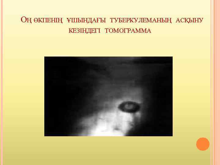 ОҢ ӨКПЕНІҢ ҰШЫНДАҒЫ ТУБЕРКУЛЕМАНЫҢ АСҚЫНУ КЕЗІНДЕГІ ТОМОГРАММА 