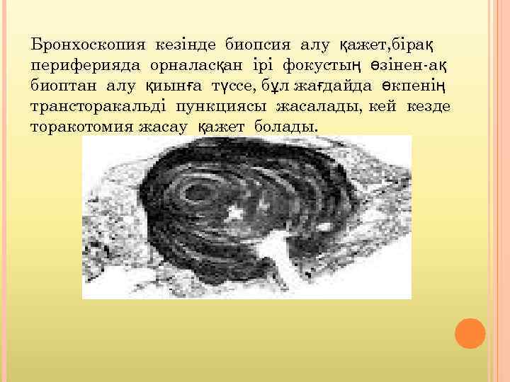 Бронхоскопия кезінде биопсия алу қажет, бірақ периферияда орналасқан ірі фокустың өзінен-ақ биоптан алу қиынға