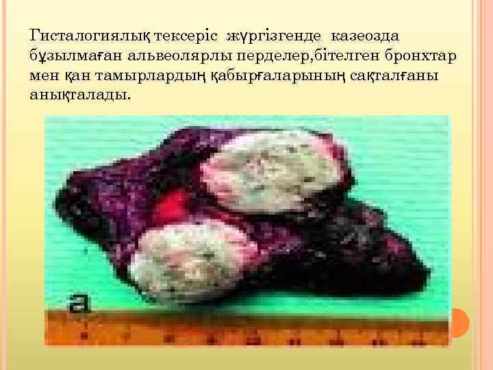 Гисталогиялық тексеріс жүргізгенде казеозда бұзылмаған альвеолярлы перделер, бітелген бронхтар мен қан тамырлардың қабырғаларының сақталғаны
