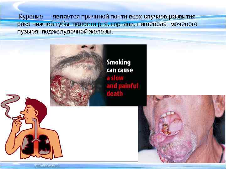 Курение — является причиной почти всех случаев развития рака нижней губы, полости рта, гортани,